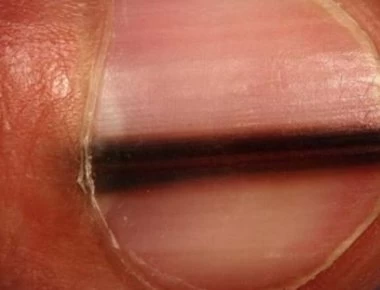 Τι σημαίνει αν σχηματιστεί μια μαύρη γραμμή στο νύχι σας – Μην το αγνοήσετε